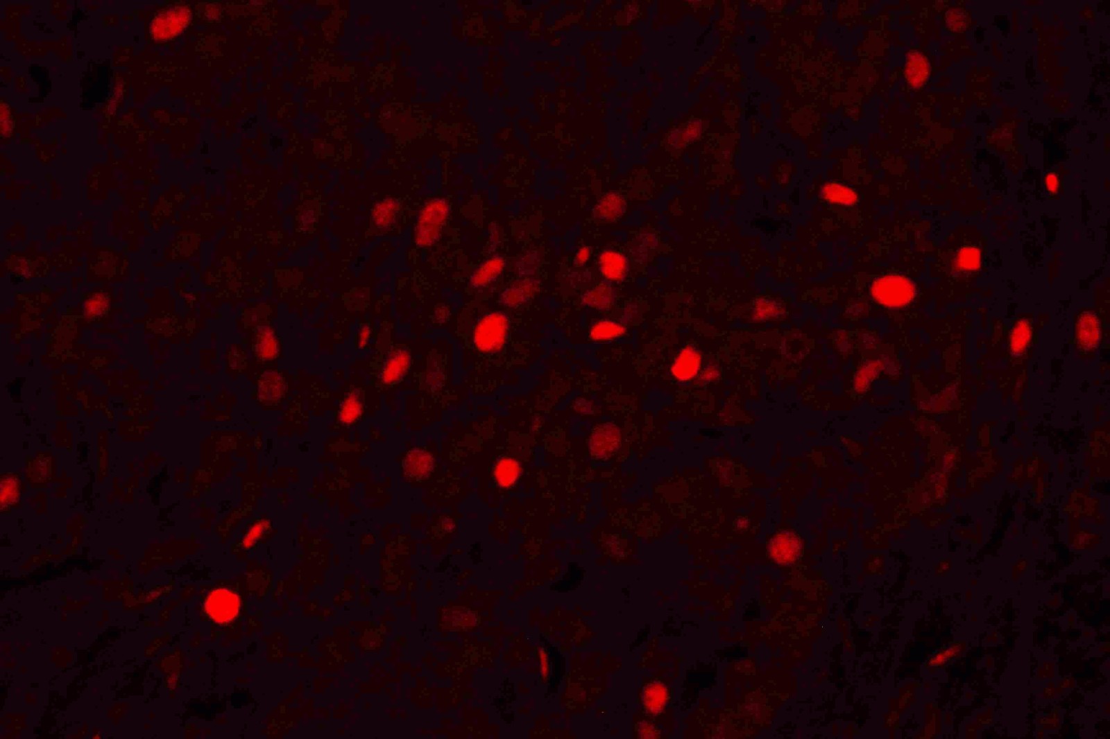 图 1. 使用 Anti-PCNA 抗体 (BM0104) 在人肺癌组织石蜡包埋切片中检测到的 IF 分析。 组织切片使用 TRITC 共轭 AffiniPure 山羊抗小鼠 IgG (H+L) 二抗（红色）（目录号？#？BA1089）染色，并用 DAPI（蓝色）复染。