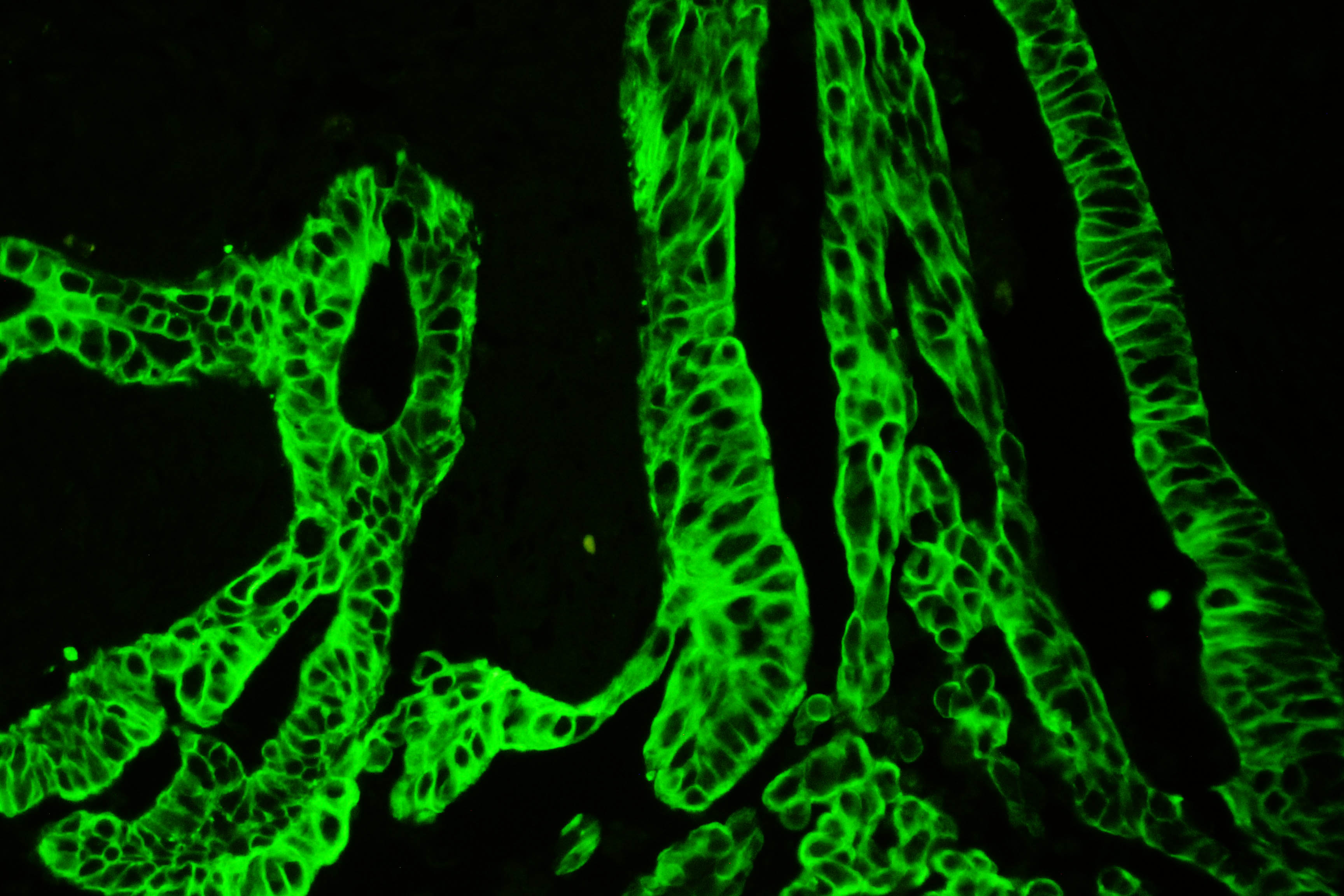 图1.使用Anti-PCK抗体(BM0034)在人肠癌组织石蜡包埋切片中检测到的IF分析。 组织切片使用 FITC Conjugated AffiniPure Goat Anti-mouse IgG (H+L) 二抗（绿色）（Catalog?#?BA1101）染色，并用 DAPI（蓝色）复染。